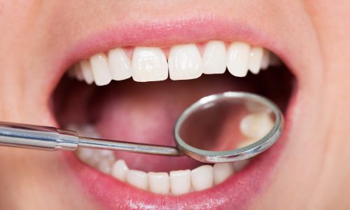 Close-up Of Woman Having Her Dental Checkup